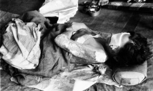 A Nagasaki victim who had received medical care in August 1945.