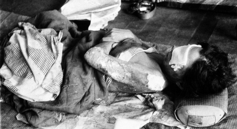 Пострадавший, который уже получил медицинскую помощь (31 августа 1945 года. Нагасаки, Япония)