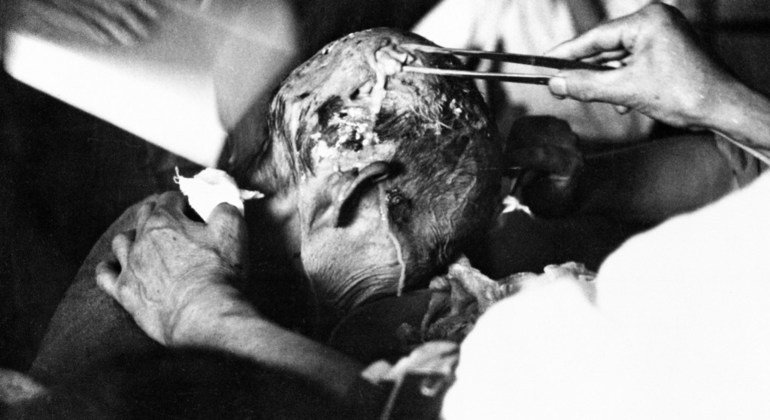 Uma vítima de Nagasaki recebe tratamento médico no final de agosto de 1945