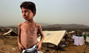 यमन के उत्तरी हिस्से में भारी मात्रा में बारूदी सुरंगें और ख़तरनाक़ विस्फोट मौजूद हैं, मगर बहुत से बच्चों को उनके ख़तरों के बारे में जानकारी नहीं है, 11 वर्षीय एक लड़का एक ऐसे ही विस्फोटक की चपेट में आने से ज़ख़्मी हो गया.
