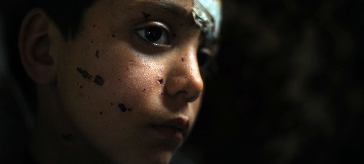 सीरिया से लेबनान जाने के लिए अपने परिवार के साथ सीमा पार करते समय अज्ञात विस्फोटकों से घायल हुआ नौ वर्षीय एक बच्चा. विस्फोटकों के निशान उसके चेहरे पर देखे जा सकते हैं.