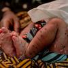 Une fillette de trois semaines atteinte de mpox aux urgences de l'hôpital de Kavumu au Sud-Kivu, en République démocratique du Congo (photo d'archives)