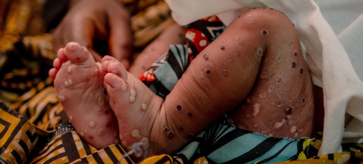 A three-week-old girl suffering from mpox in the emergency room at Kavumu Hospital in South Kivu, Democratic Republic of the Congo. (file)