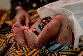 Uma menina de três semanas sofrendo de mpox na sala de emergência do Hospital Kavumu em Kivu do Sul, República Democrática do Congo. (arquivo)