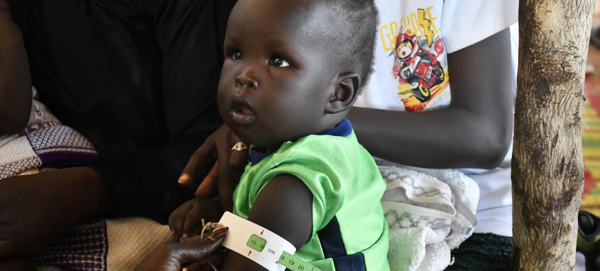 Un enfant au Soudan du Sud est examiné pour détecter les signes de malnutrition.