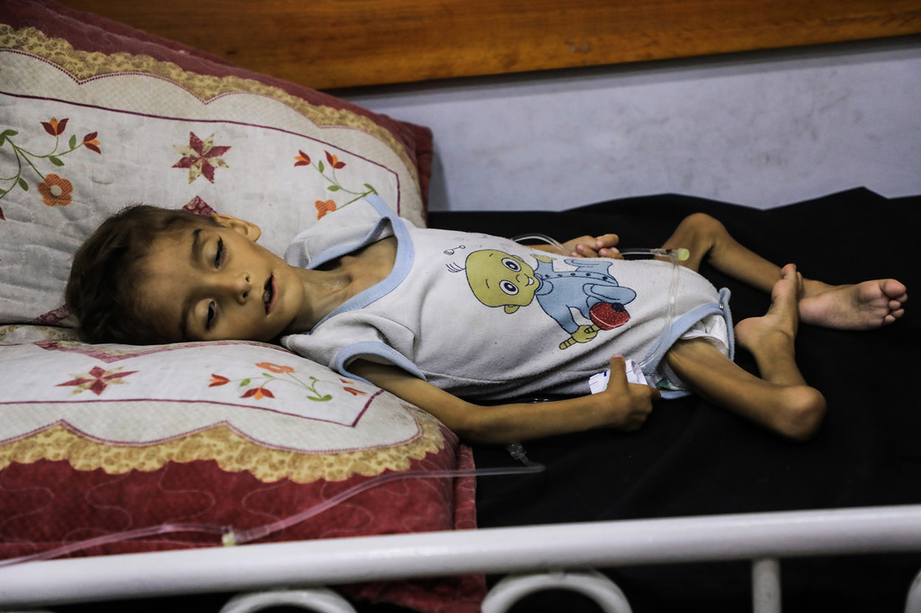 Un enfant souffrant de malnutrition est allongé sur un lit à l'hôpital Patient Society de la ville de Gaza.