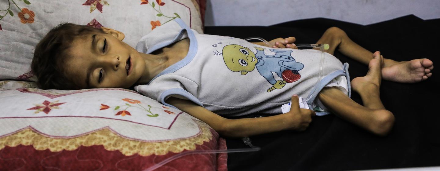 Un enfant souffrant de malnutrition est allongé sur un lit à l'hôpital Patient Society de la ville de Gaza.