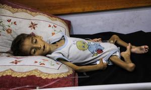 Un niño gravemente desnutrido ingresado en un hospital de la ciudad de Gaza.