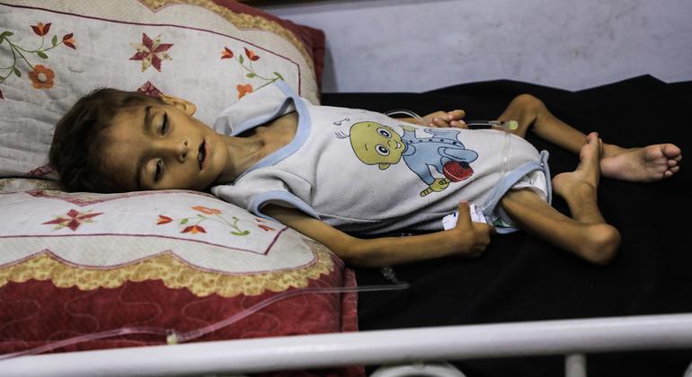 A child suffering from malnutrition lies on a bed in the Patient Society Hospital in Gaza City .