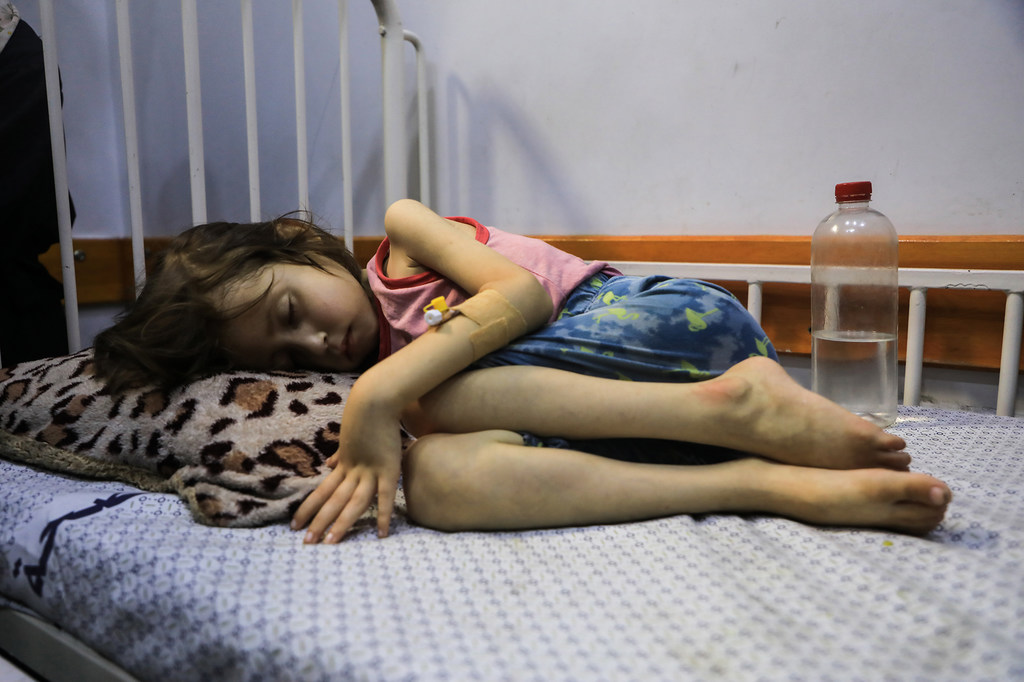 Un enfant souffrant de malnutrition est allongé sur un lit à l'hôpital Patient Society de la ville de Gaza.