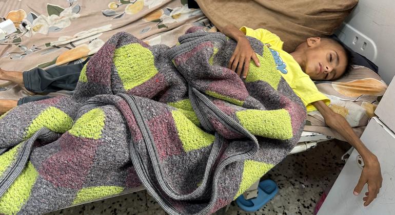 Un niño con desnutrición grave descansa en un hospital de Gaza. Un niño con desnutrición grave descansa en un hospital de Gaza.