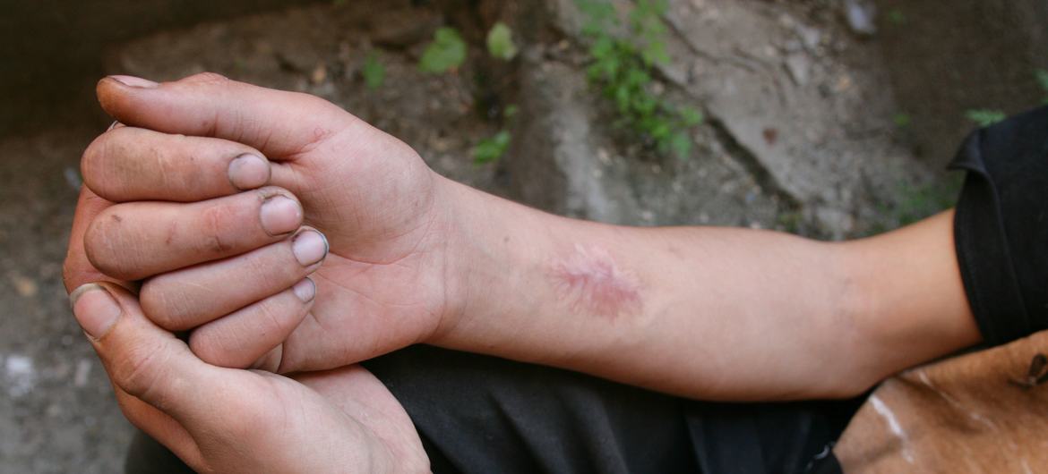 Mains d’un consommateur de drogues injectables à Odessa, dans le sud de l’Ukraine.
