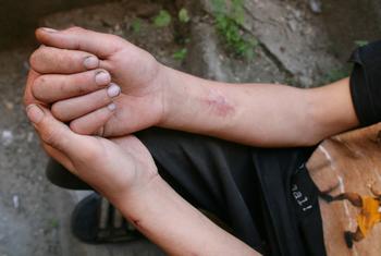 दक्षिणी यूक्रेन के ओडेसा शहर में ड्रग्स का सेवन करने वाले एक व्यक्ति के हाथ पर इंजेक्शन के निशान.