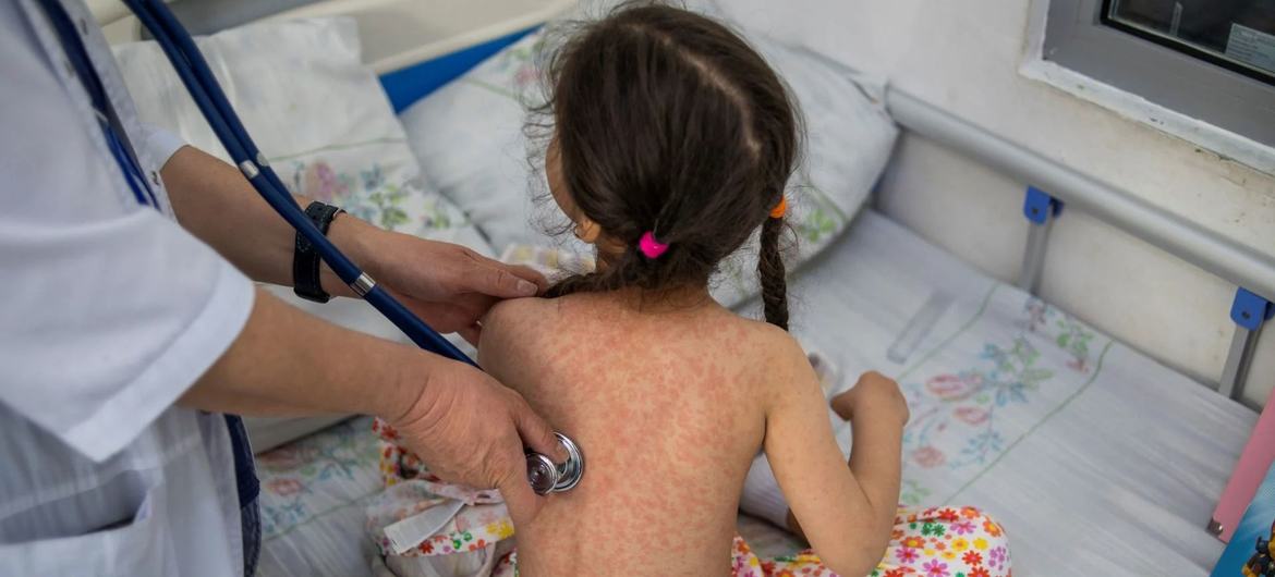 Uma menina recebe tratamento para sarampo