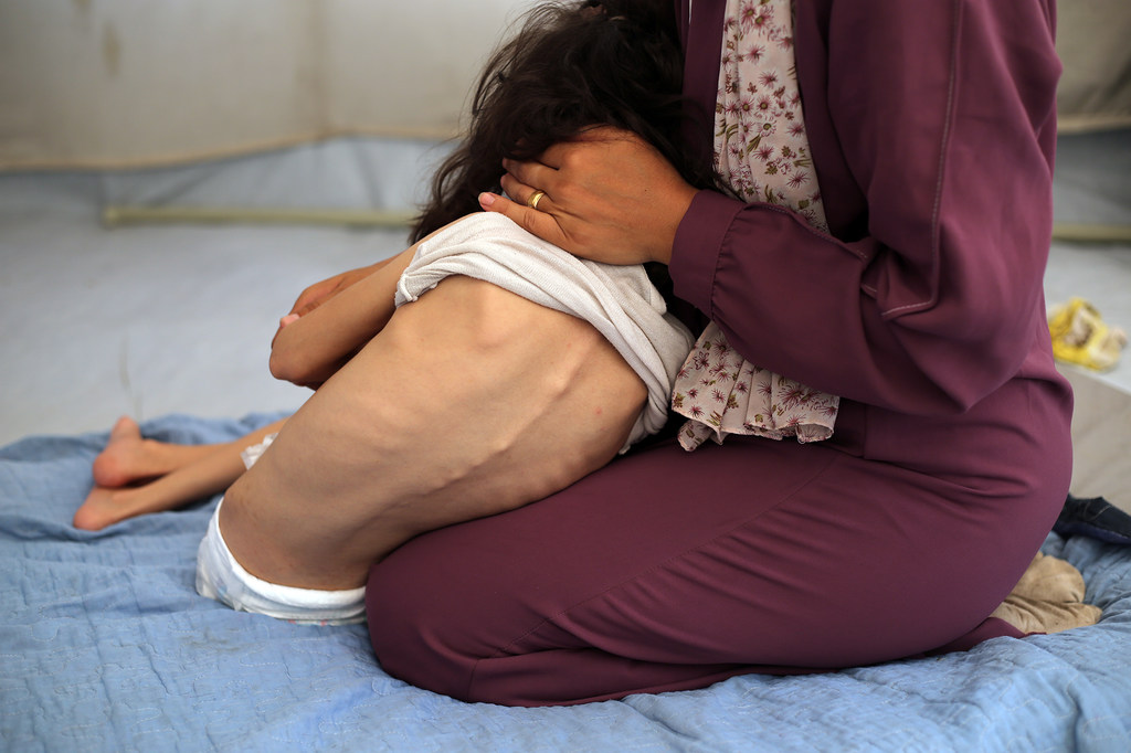 Une jeune fille souffrant de malnutrition grave à Gaza a besoin d'aide pour enfiler ses vêtements.