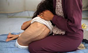 Una niña pequeña con desnutrición grave recibe ayuda para vestirse.
