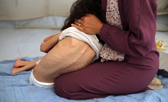 Una niña pequeña con desnutrición grave recibe ayuda para vestirse.