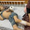 Une jeune fille sous-alimentée est allongée sur un lit d'hôpital à Gaza, recevant des soins médicaux pour une blessure à la jambe, tandis qu'une femme s'occupe d'elle.