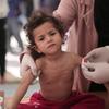 تظهر على العديد من الأطفال في غزة علامات سوء التغذية الحاد وفقدان الوزن بشكل كبير.