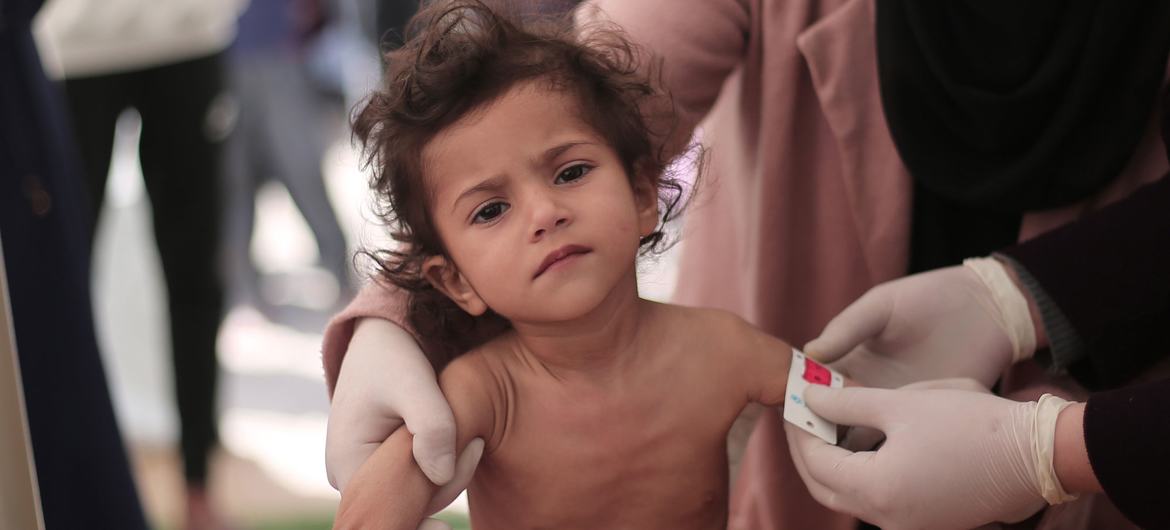 加沙北部六分之一的两岁以下儿童严重营养不良。