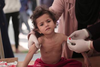 Muchos niños de Gaza muestran signos de desnutrición aguda grave y pérdida drástica de peso.