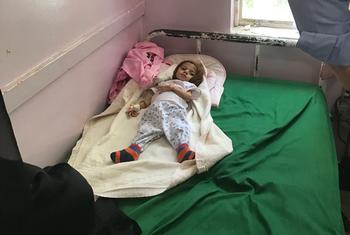 Niño desnutrido en un hospital infantil de Saná, Yemen.