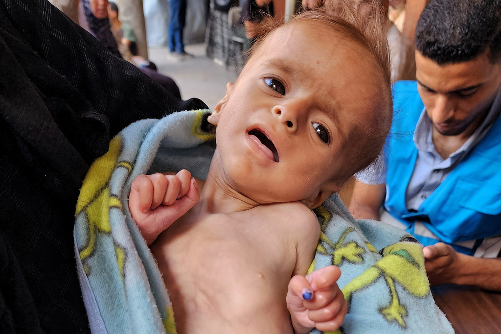 Salam, de seis meses, es examinado por desnutrición en un punto médico de la UNRWA en la ciudad de Gaza.