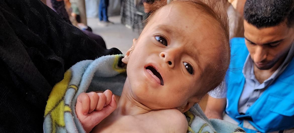 سلام، البالغة من العمر ستة أشهر، يتم فحصها لسوء التغذية في نقطة طبية تابعة للأونروا في مدينة غزة.