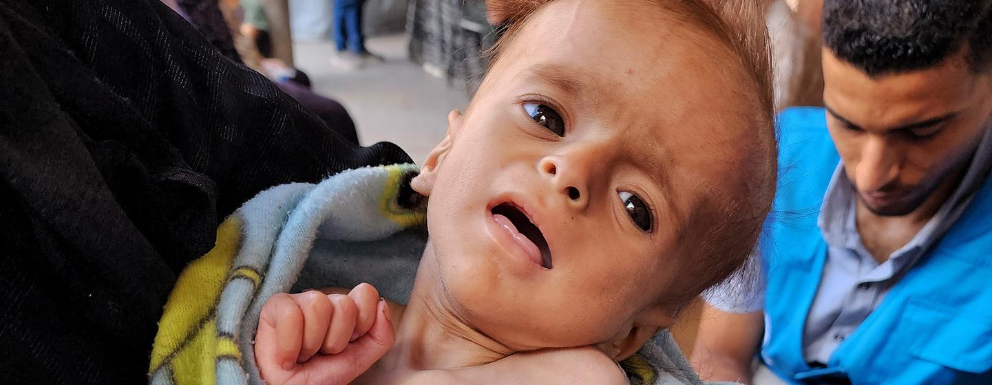Salam, six months old, is screened for malnutrition at an UNRWA medical point in Gaza City. Salam, six months old, is screened for malnutrition at an UNRWA medical point in Gaza City.