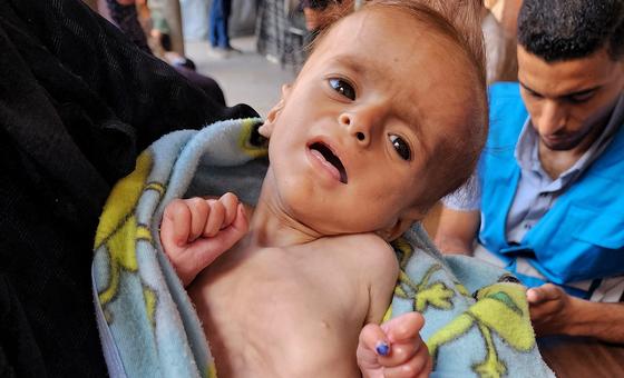 Salam, de seis meses, es examinado por desnutrición en un punto médico de la UNRWA en la ciudad de Gaza.