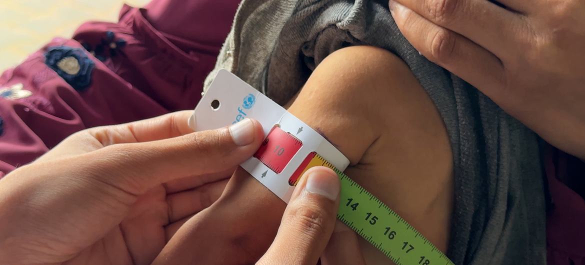 A growing number of children are being screened for malnutrition in Gaza. A growing number of children are being screened for malnutrition in Gaza.