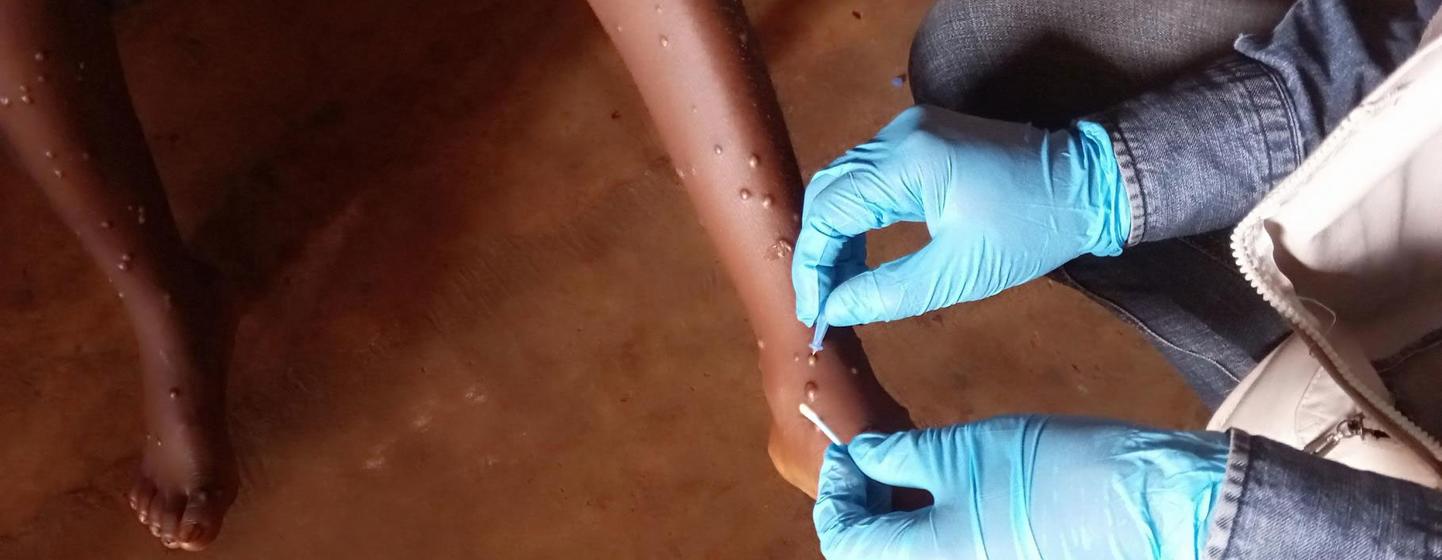 WHO is scaling up response to curb a growing mpox outbreak in the African region.