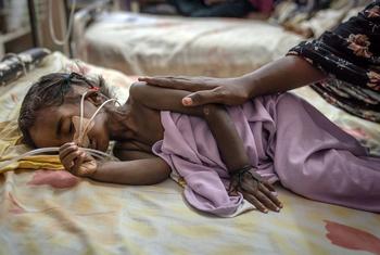 A severely malnourished two-year-old girl, Riham Ata, lies on a gurney in Al-Buluk Hospital's pediatric ward in Omdurman, Sudan, receiving medical care after being admitted from a recently liberated area of Khartoum.
