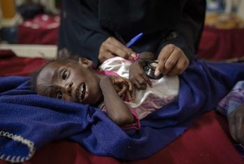 Un enfant de trois ans est soigné pour malnutrition dans un hôpital d'Omdurman, au Soudan. Un enfant de trois ans est soigné pour malnutrition dans un hôpital d'Omdurman, au Soudan.