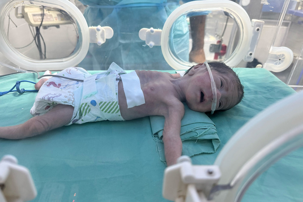Un bebé gravemente desnutrido recibe tratamiento en el hospital Al Helou en Gaza.