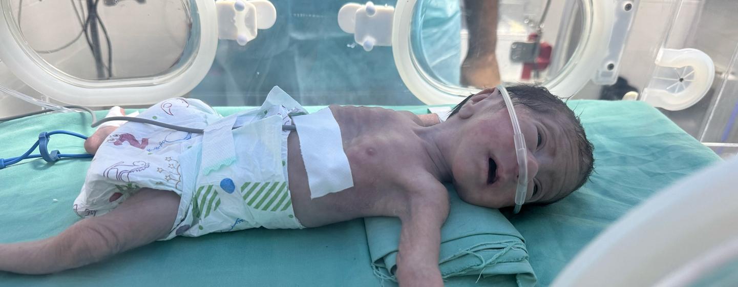 Mtoto mwenye utapiamlo anatibiwa katika Hospitali ya Al Helou huko Gaza