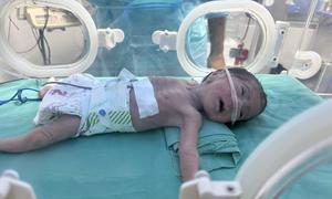 Un bebé gravemente desnutrido recibe tratamiento en el hospital Al Helou en Gaza.