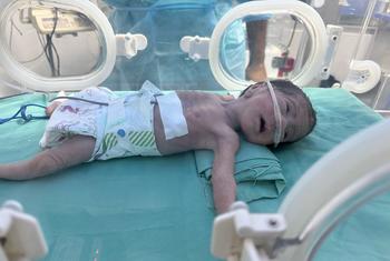Un bebé gravemente desnutrido recibe tratamiento en el hospital Al Helou en Gaza.