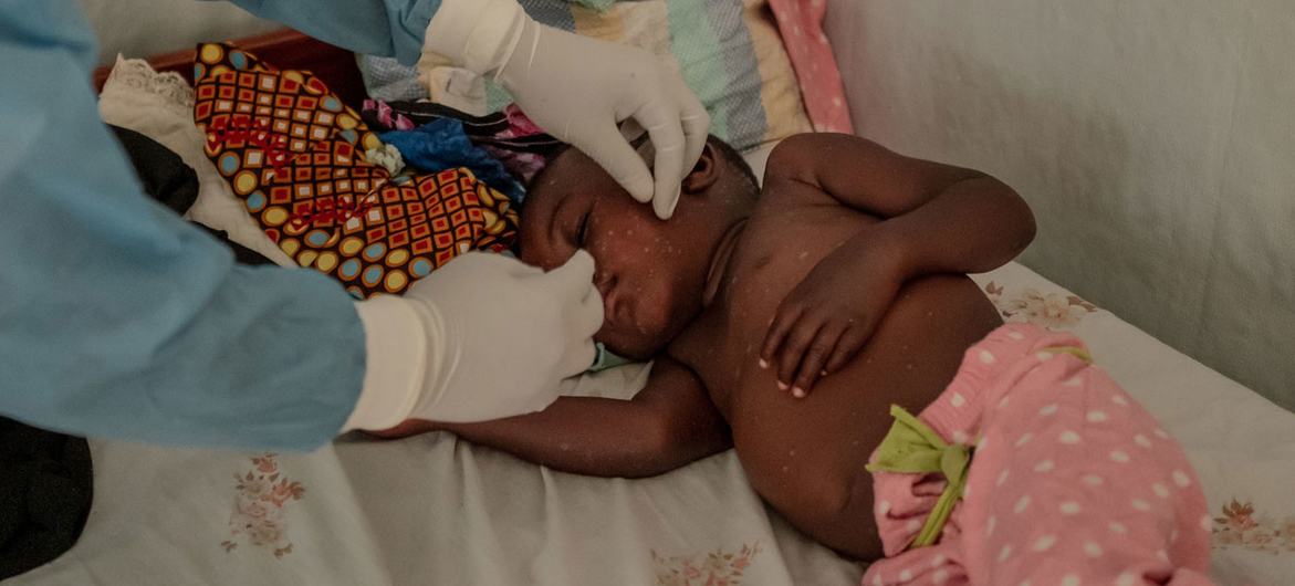 A health worker checks on a two-year-old boy being treated for mpox in northern Goma, Democratic Republic of Congo.