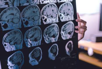 Mtu anashikilia filamu yenye skani nyingi za MRI za ubongo, ikionyesha kudhoofika kwa lobe ya mbele.