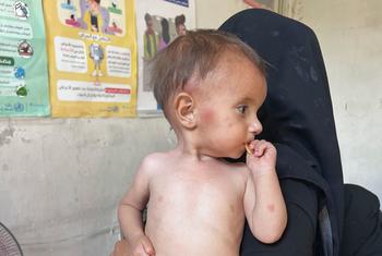 أم وطفلها ينتظران في عيادة لعلاج سوء التغذية في حلب، سوريا.