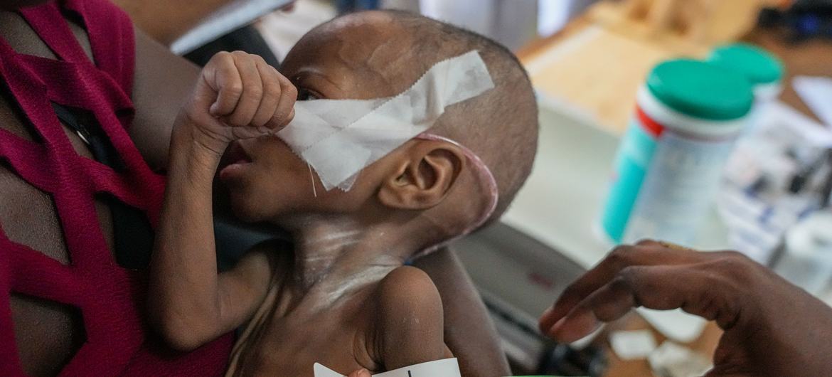 A malnourished child receives medical treatment in Haiti.