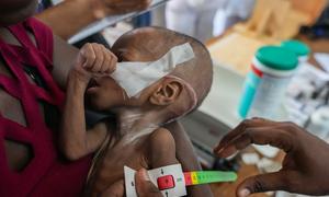 A malnourished child receives medical treatment in Haiti.