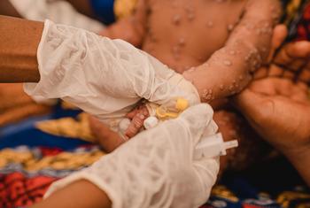 Un enfant d'un mois reçoit un traitement dans l'unité d'isolement de la variole de l'hôpital Kamanyola, soutenu par l'UNICEF, dans la province du Sud-Kivu, en République démocratique du Congo.