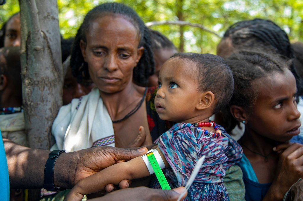 فحص طفل للكشف عن احتمال إصابته بسوء التغذية في أديكه في واجيرات بإقليم تيغراي، إثيوبيا.