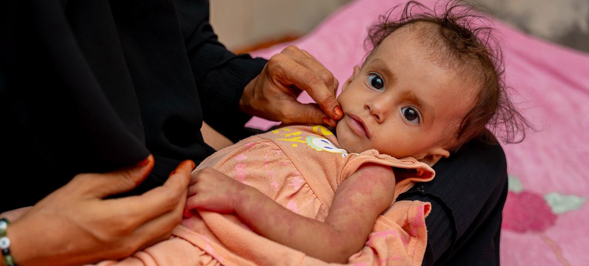 A mother holds her 10-month-old girl who is suffering from stunting and malnutrition in Abyan, Yemen. A mother holds her 10-month-old girl who is suffering from stunting and malnutrition in Abyan, Yemen.
