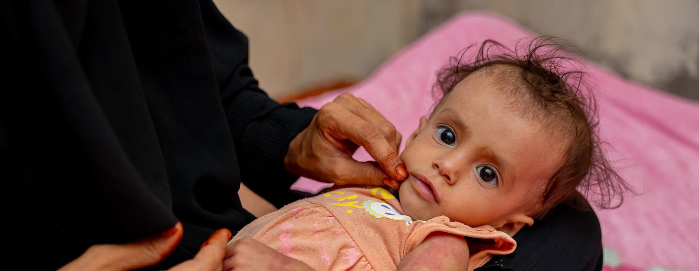 Une mère tient dans ses bras sa petite fille de 10 mois qui souffre de retard de croissance et de malnutrition à Abyan, au Yémen.