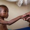 A doctor treats a toddler suffering from severe acute malnutrition and HIV at a local hospital in Katanga, DR Congo. (file)