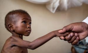 A doctor treats a toddler suffering from severe acute malnutrition and HIV at a local hospital in Katanga, DR Congo. (file)