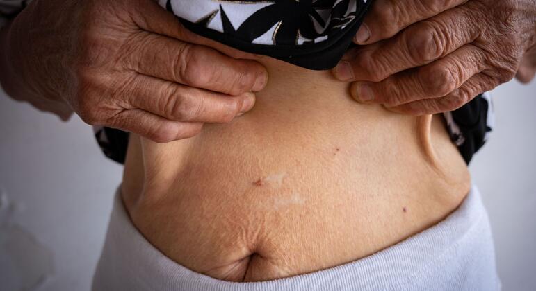 Близкое изображение туловища пожилой женщины, показывающее шрам на брюшной полости, руки, поднимающие рубашку, чтобы показать знак, символизирующие травму от сексуального насилия во время войны в Украине.